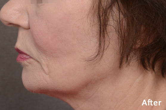 Forma Jawline Before