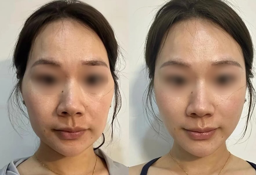 Juvederm & Radiesse Before and After