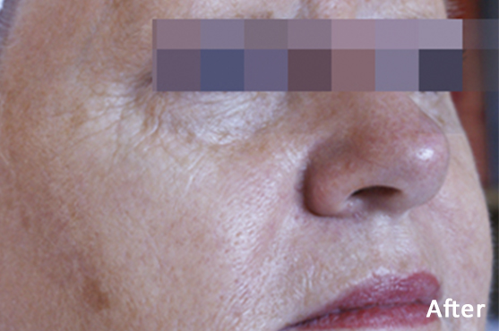 Lumecca Hyperpigmentation After
