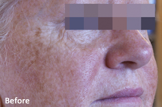 Lumecca Hyperpigmentation Before