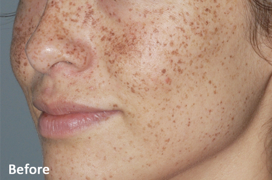 Lumecca Sun Spots Before