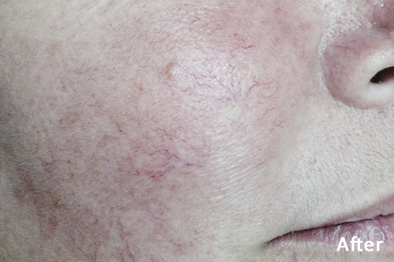 Lumecca Vascular Lesions After