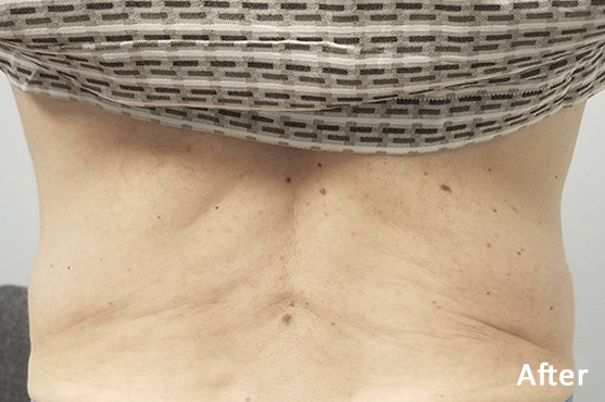 Morpheus8 Lower Back After