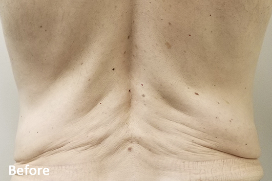 Morpheus8 Lower Back Before