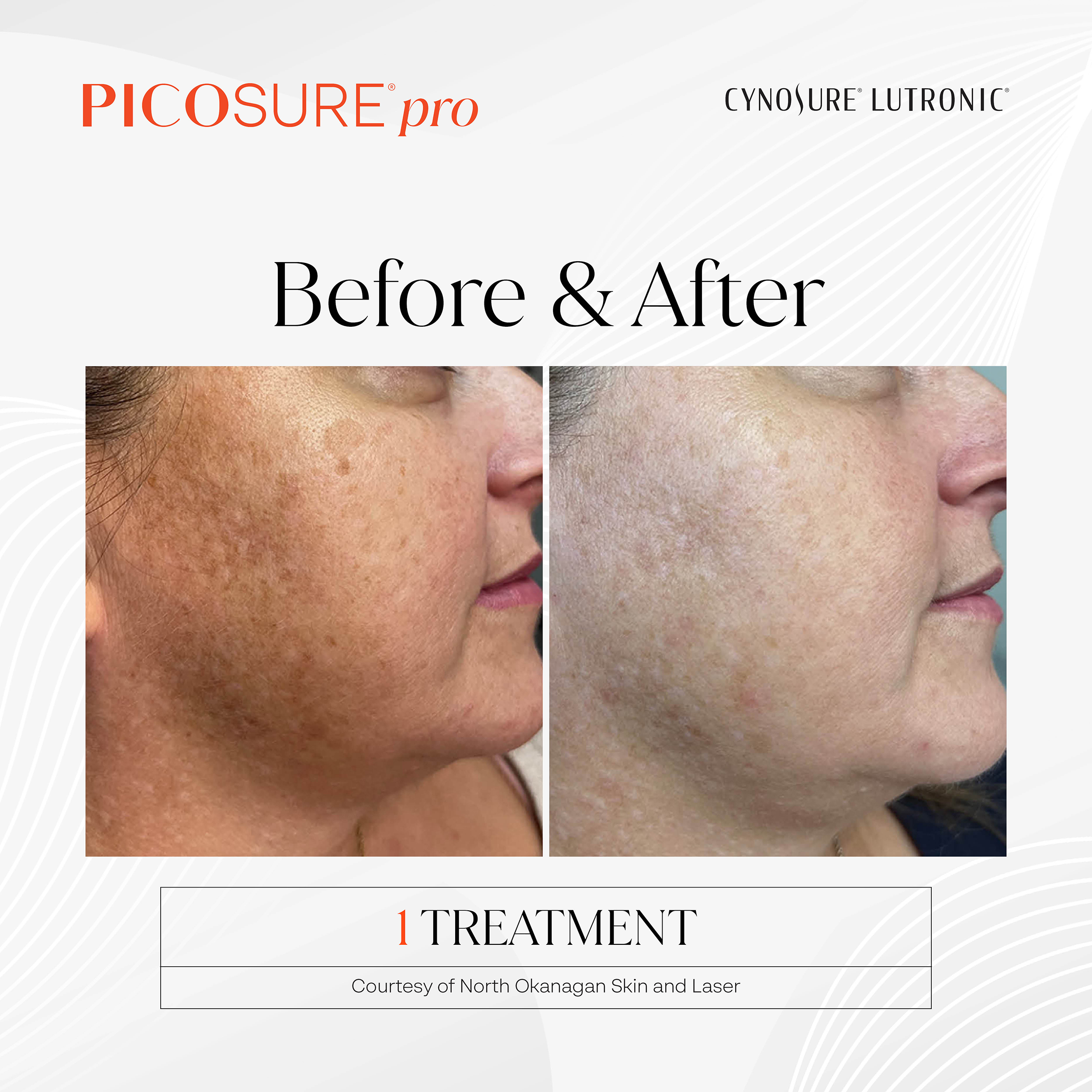PicoSure Pro Pigmentation Before and After