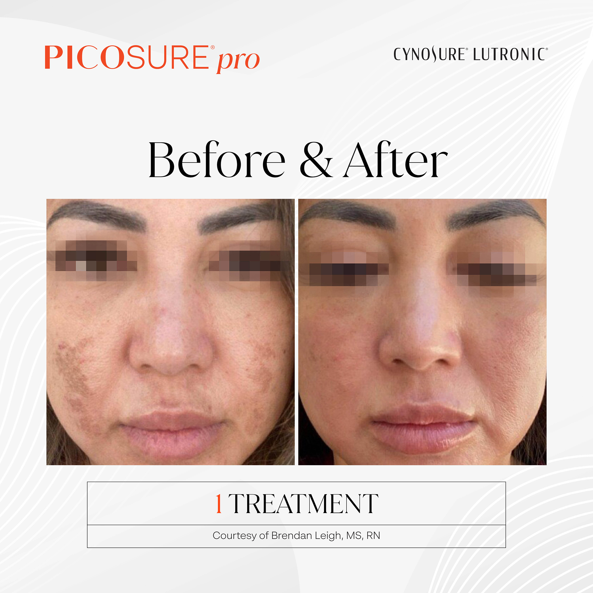PicoSure Pro Acne Scars Before and After