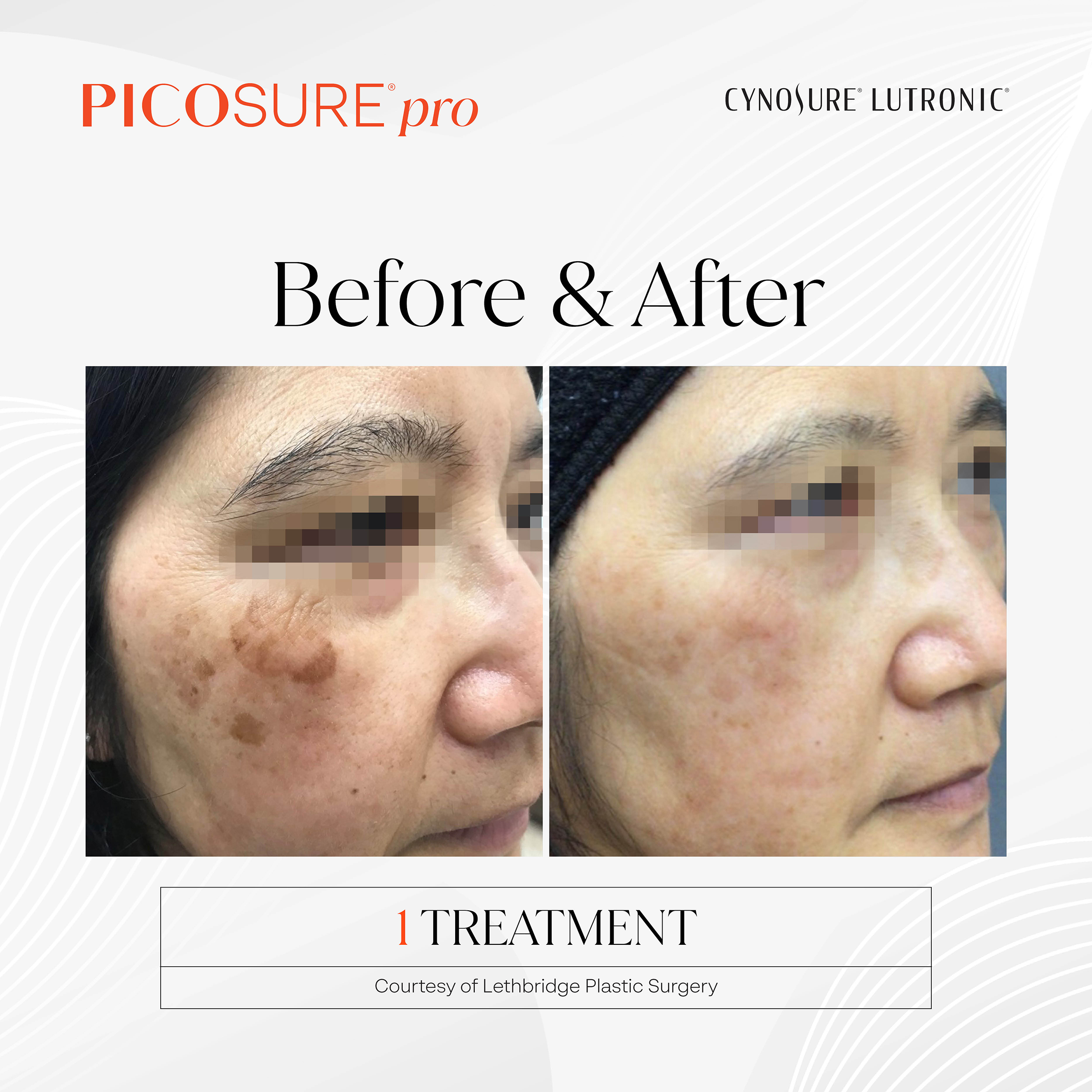 PicoSure Pro Age Spots Before and After