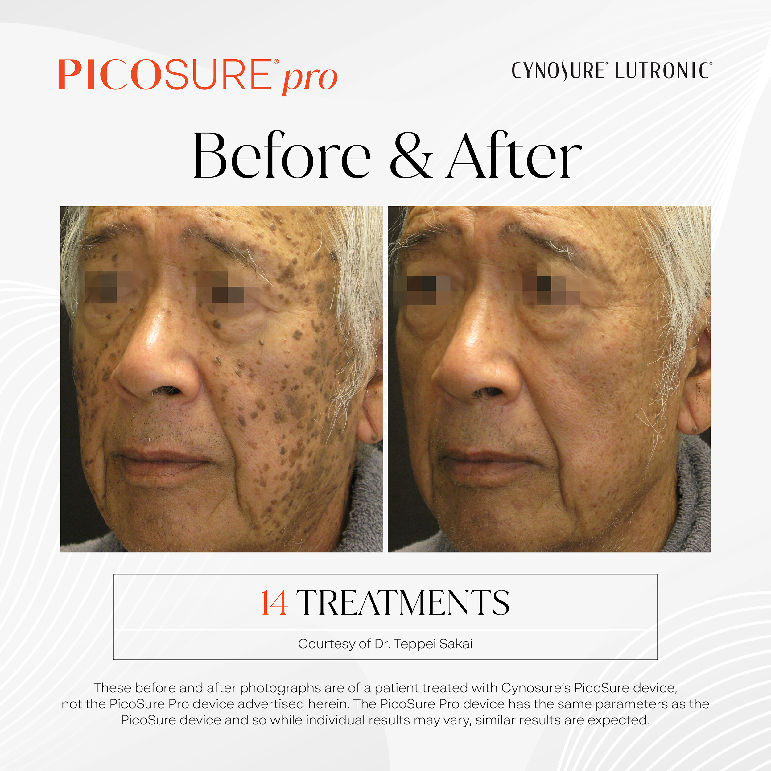 PicoSure Pro Sun Damage Before and After