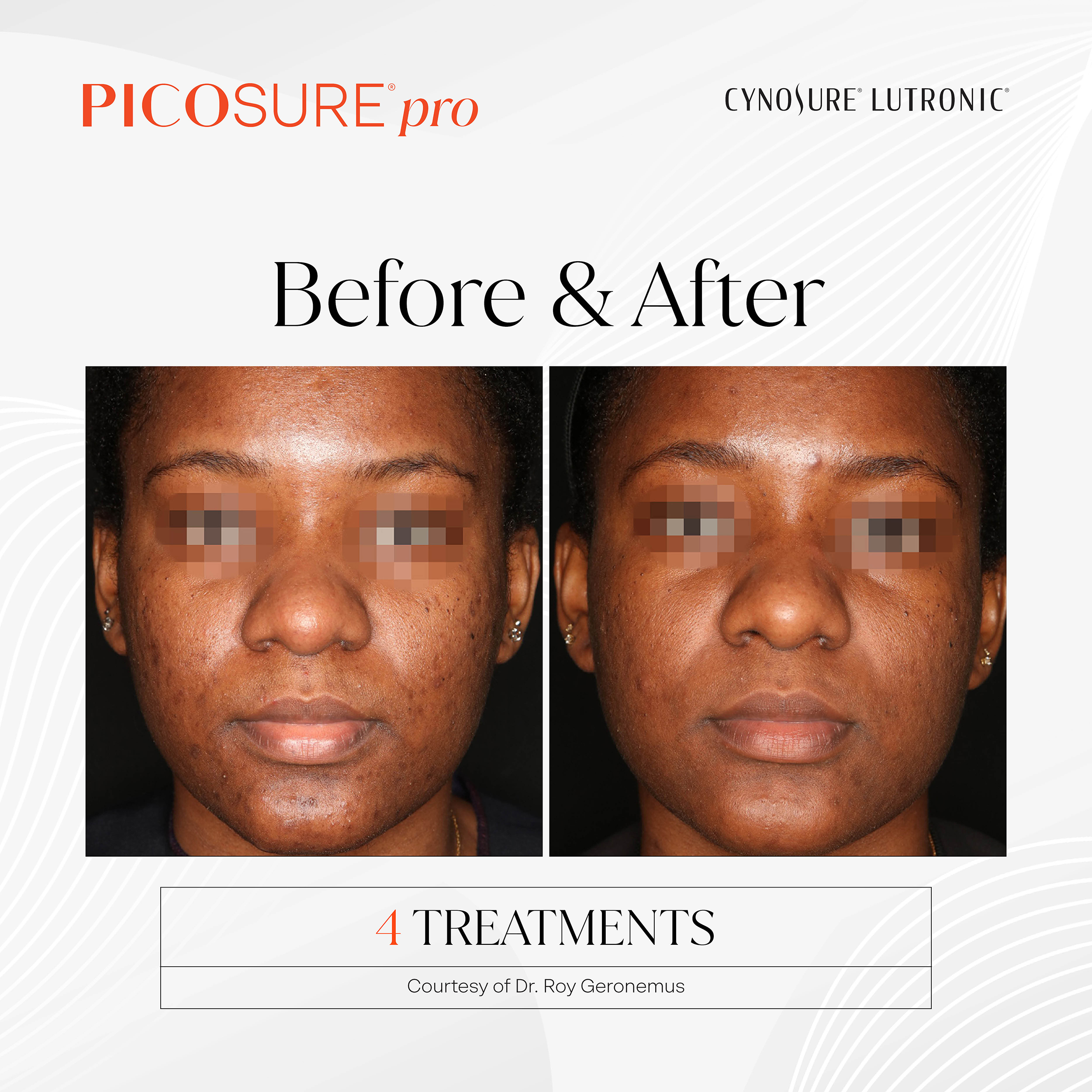PicoSure Pro Skin Tone & Texture Before and After