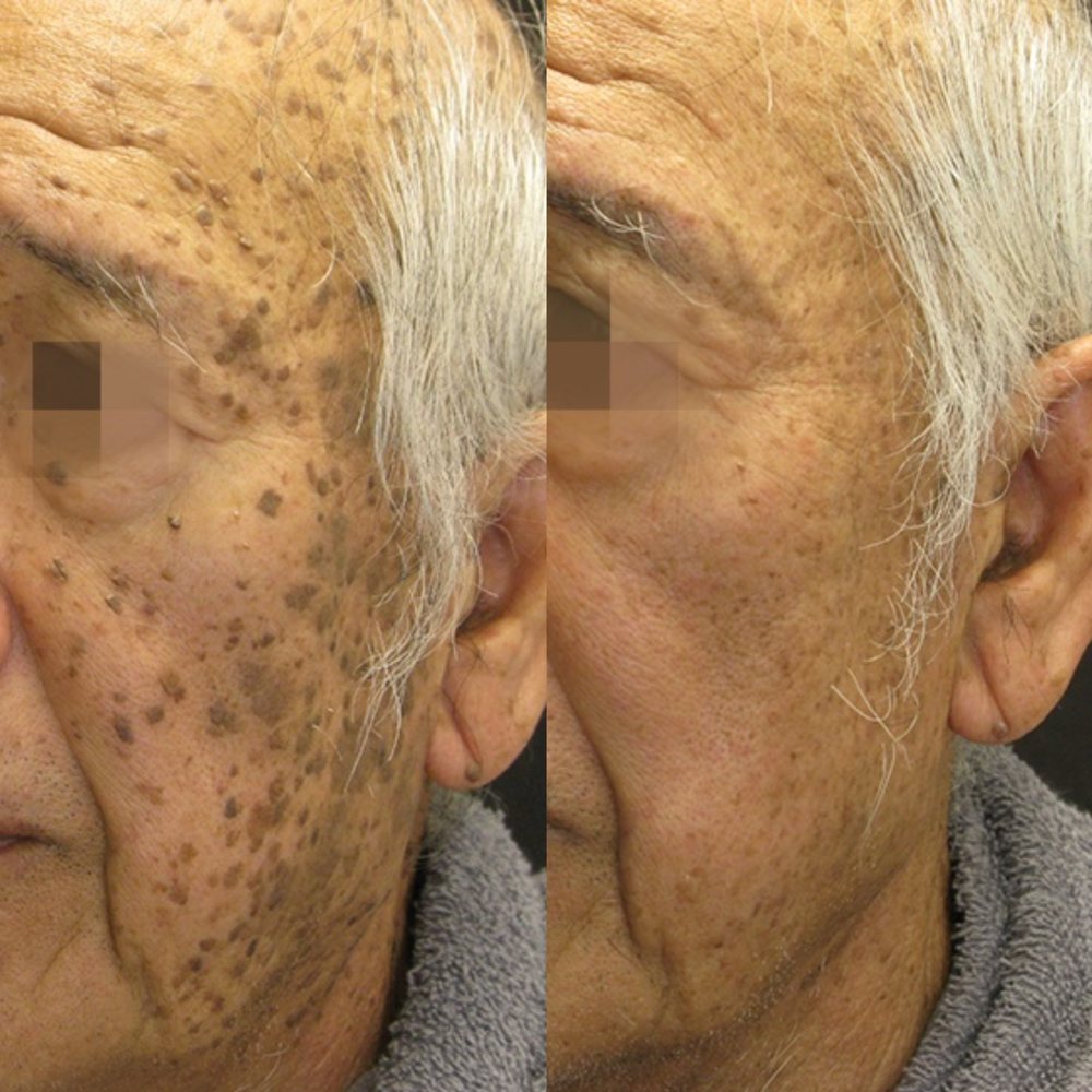 PicoSure Pro Before and After