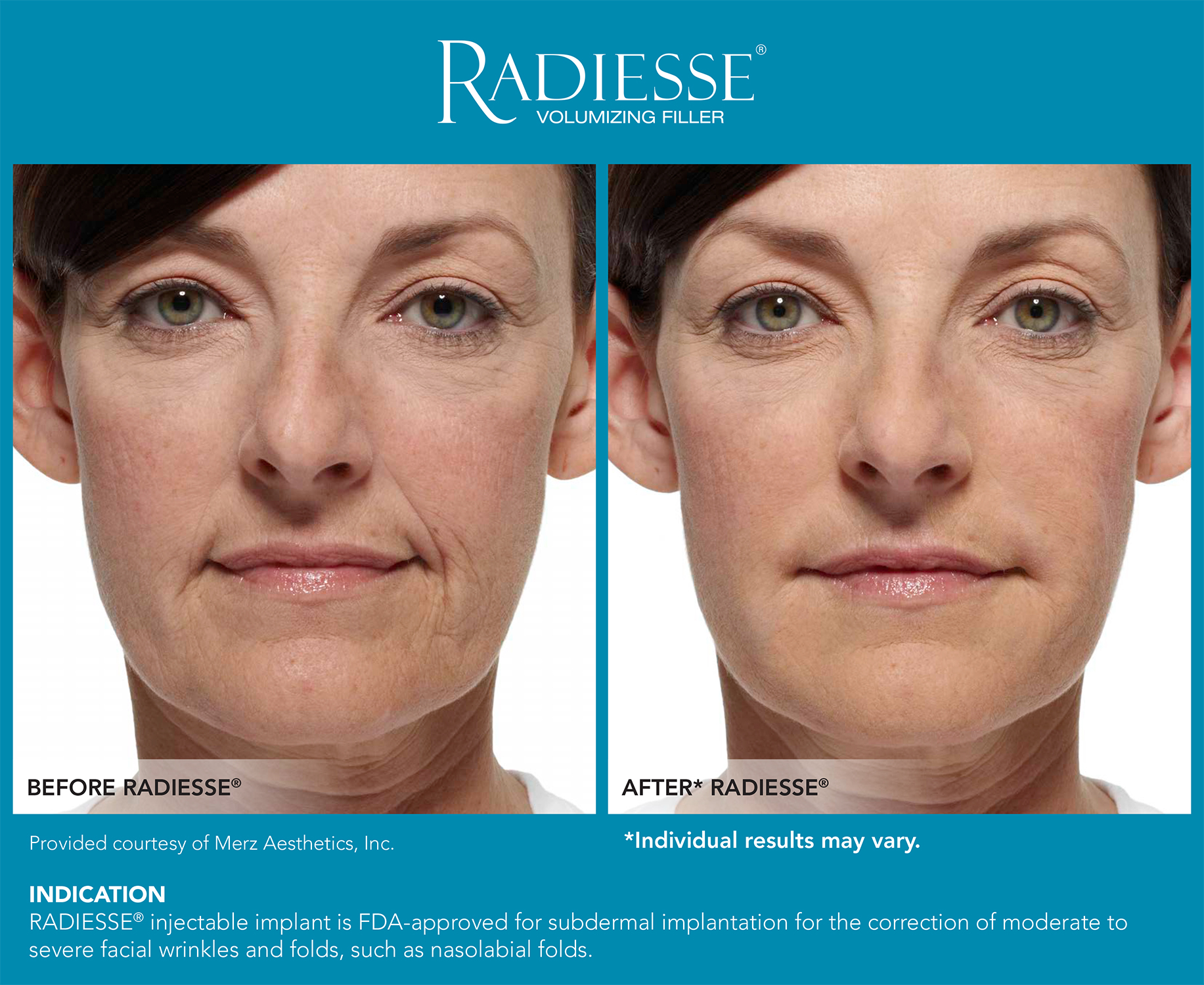 Radiesse Nasolabial Folds Before and After