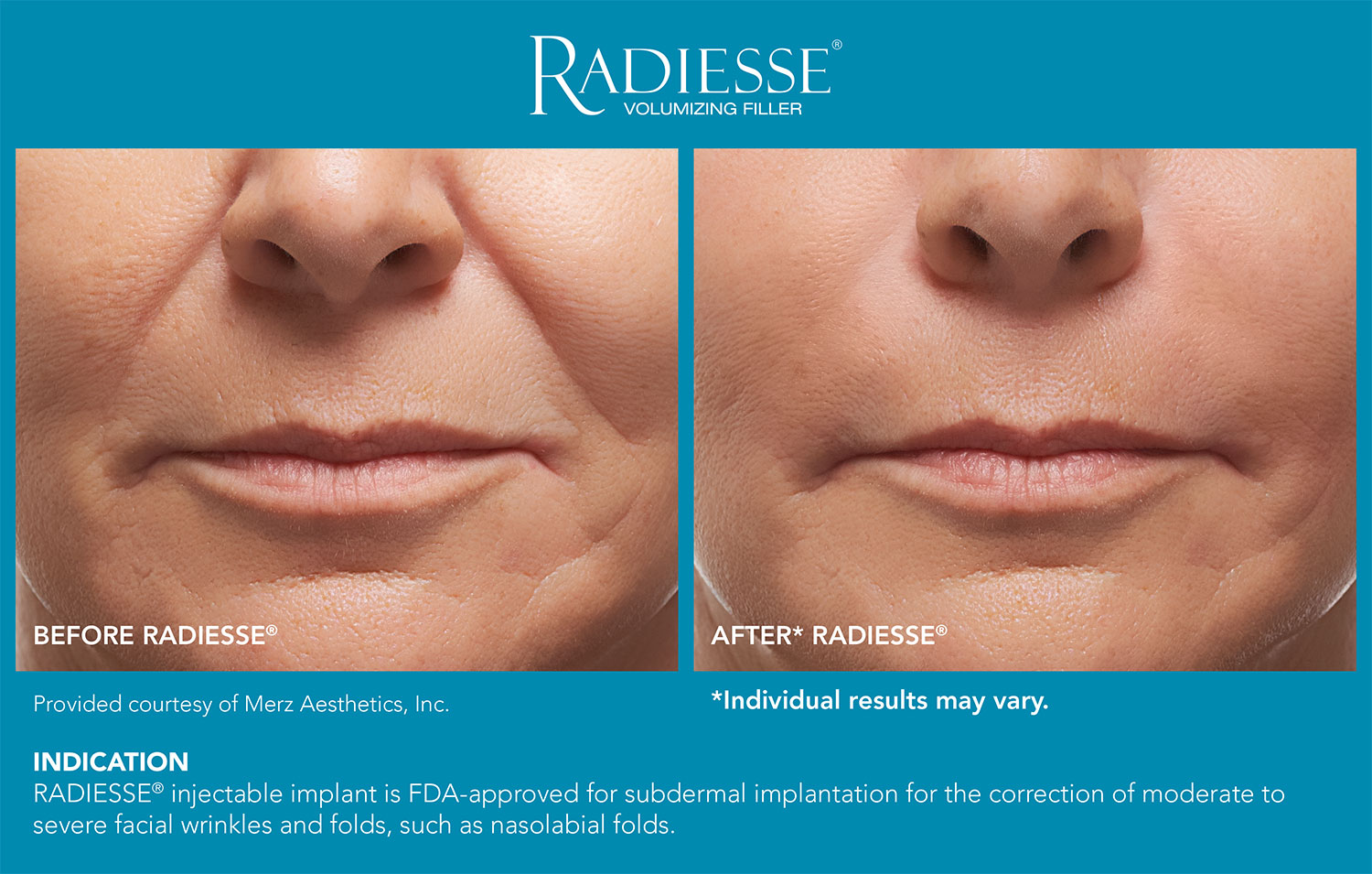 Radiesse Nasolabial Folds Before and After
