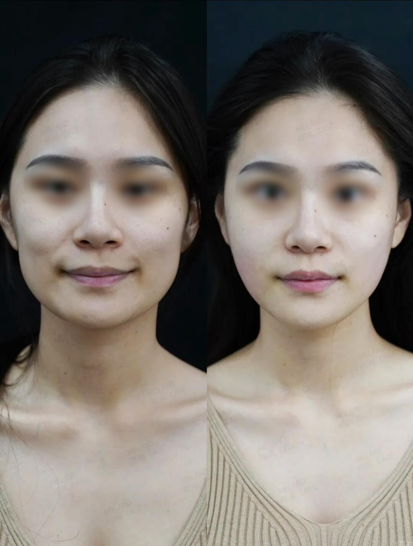 Revanesse Versa+ Before and After