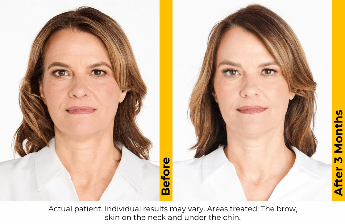 Ultherapy Brow, Neck & Chin Before and After