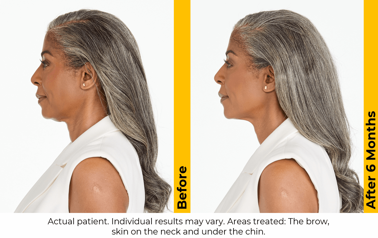 Ultherapy Neck & Jawline Before and After