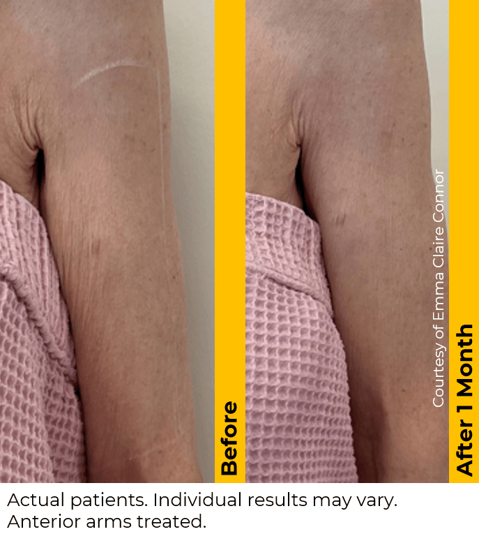 Ultherapy Arms Before and After