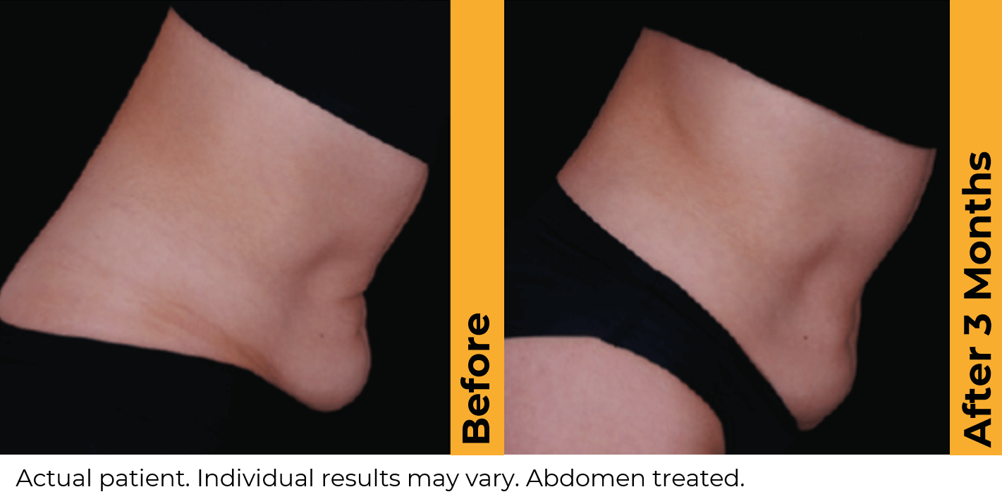 Ultherapy Abdomen Before and After