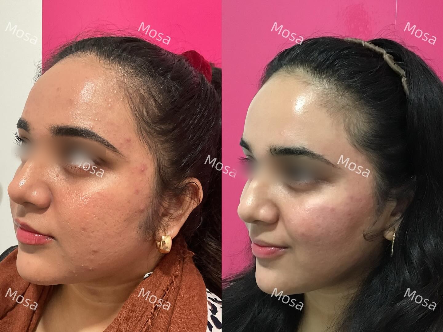 Weight Loss, Microneedling & Lumecca Before and After