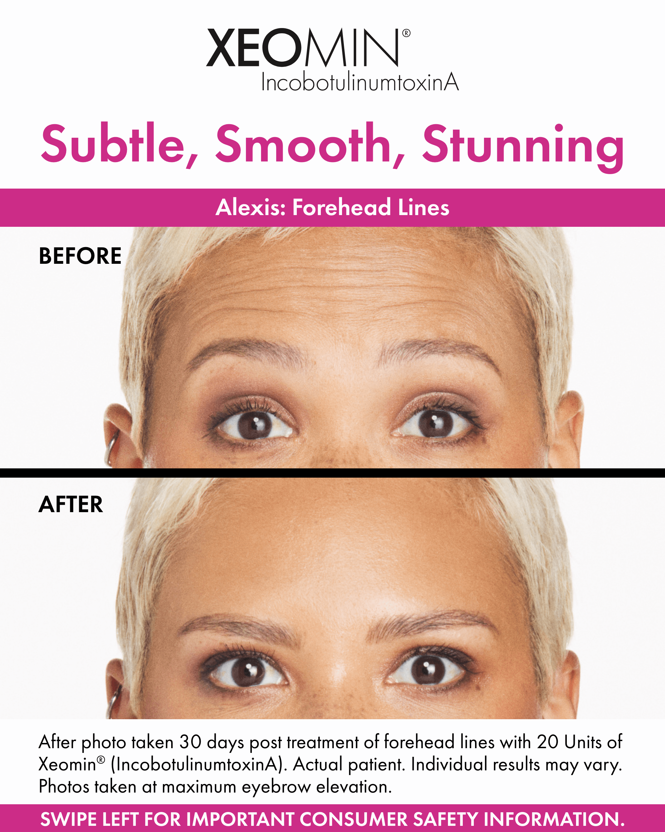 Xeomin Forehead Lines Before and After