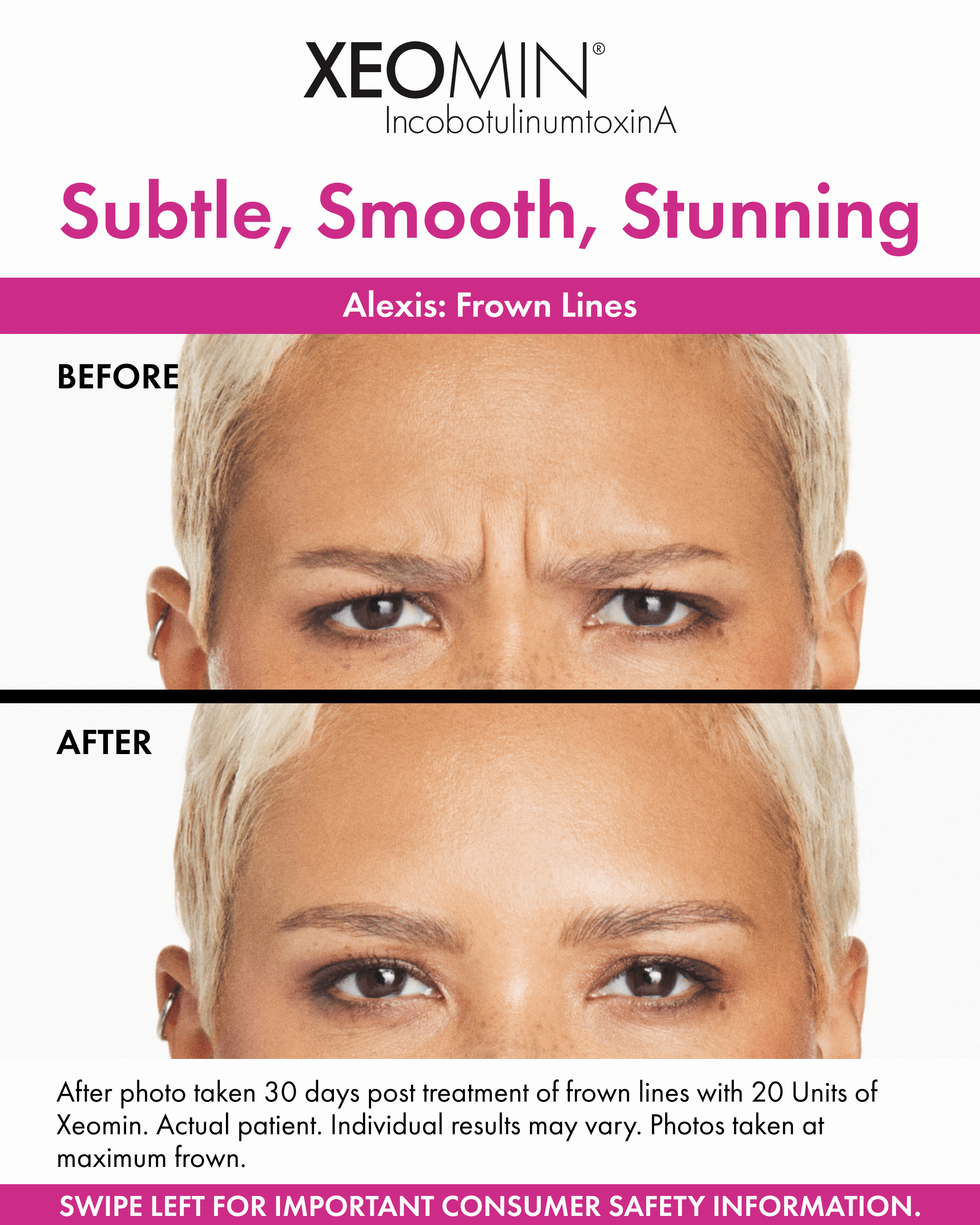 Xeomin Frown Lines Before and After