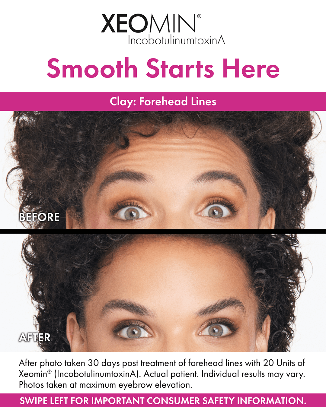 Xeomin Forehead Lines Before and After