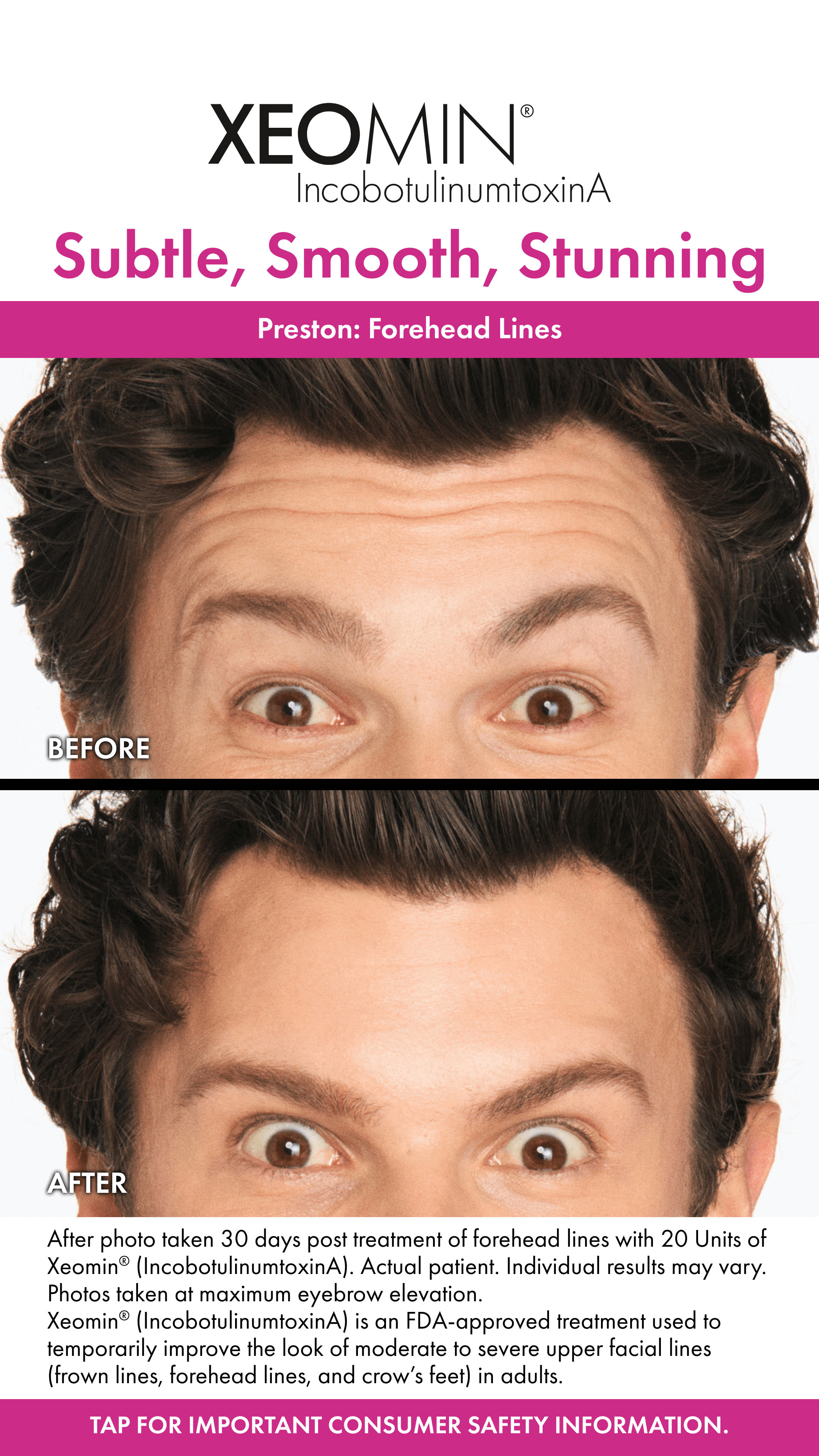 Xeomin Forehead Lines Before and After