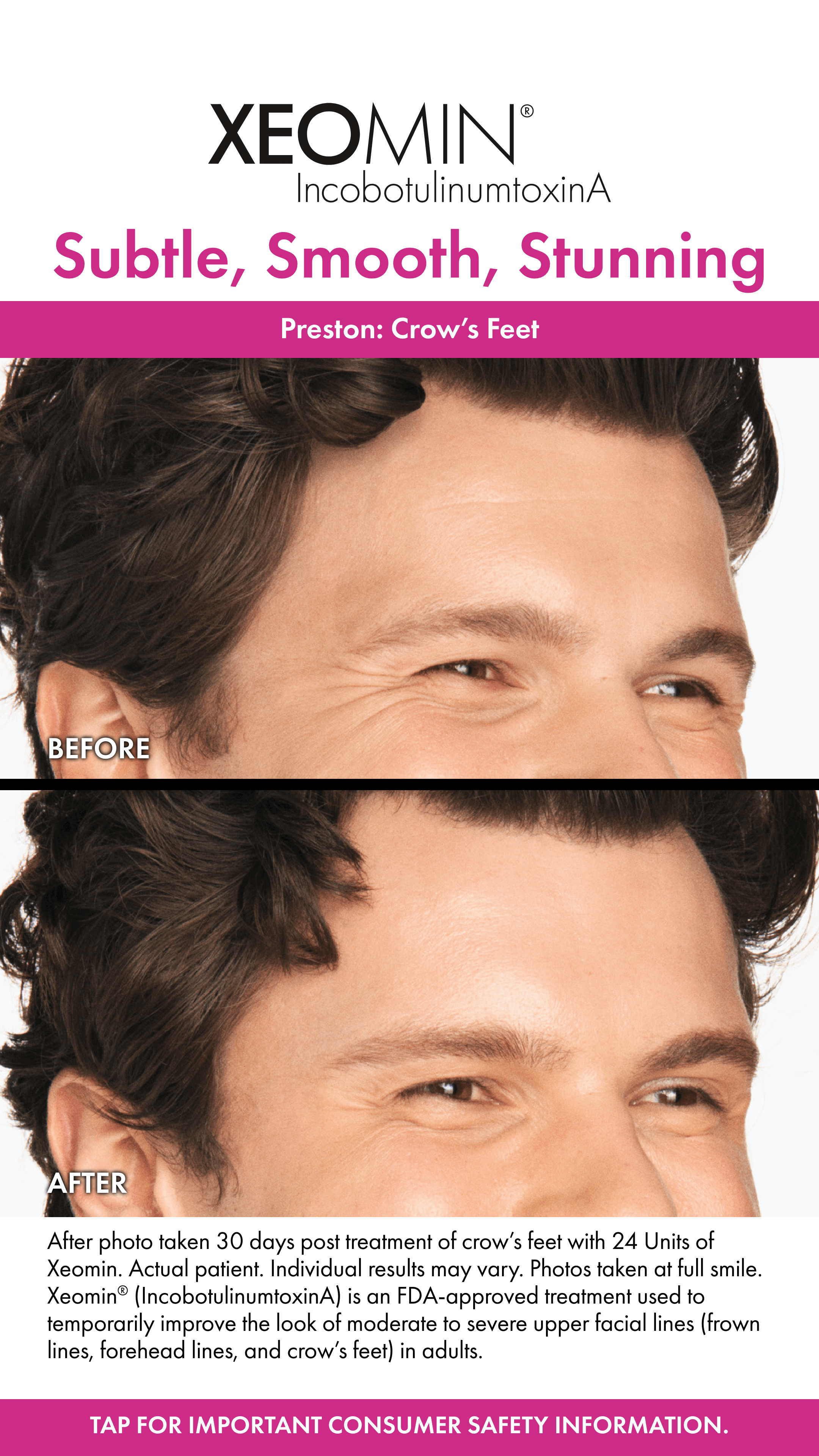 Xeomin Crow's Feet Before and After