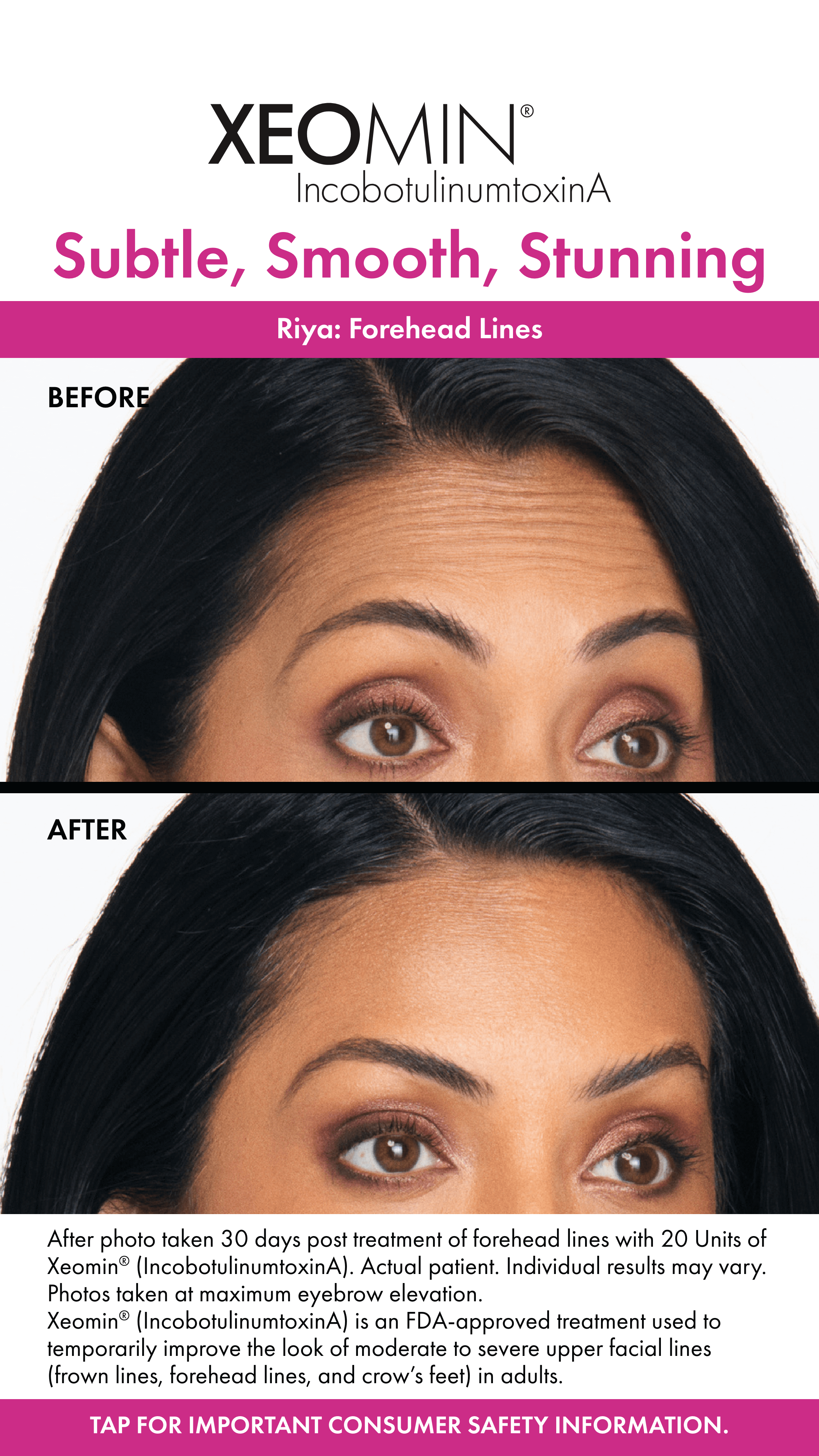 Xeomin Forehead Lines Before and After