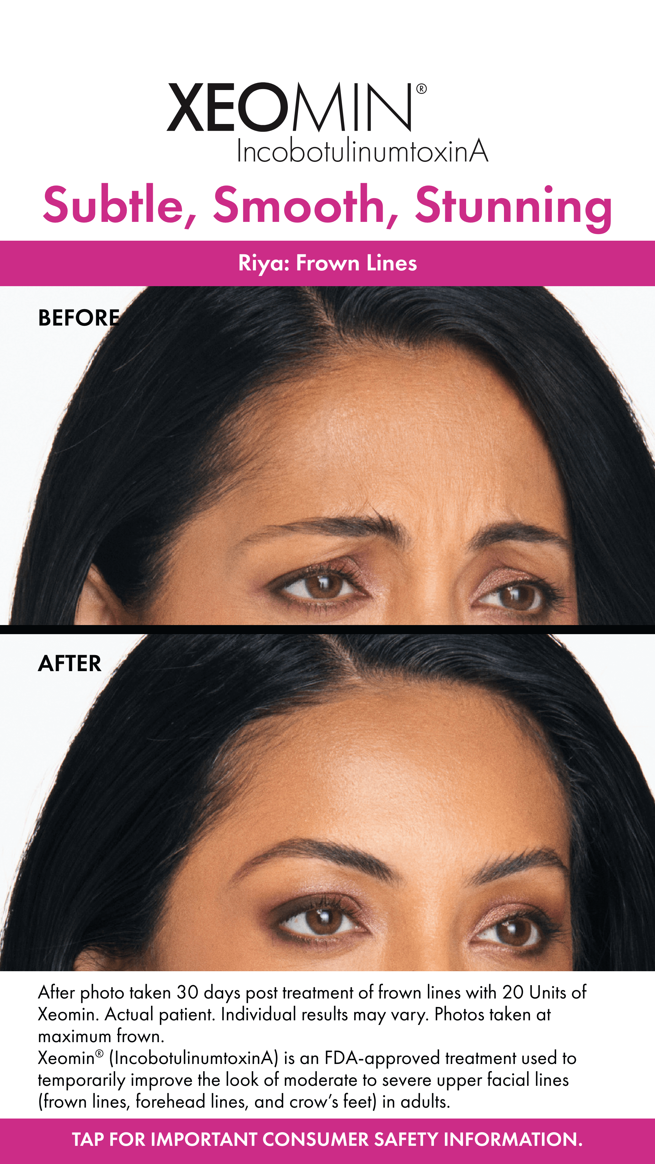 Xeomin Frown Lines Before and After